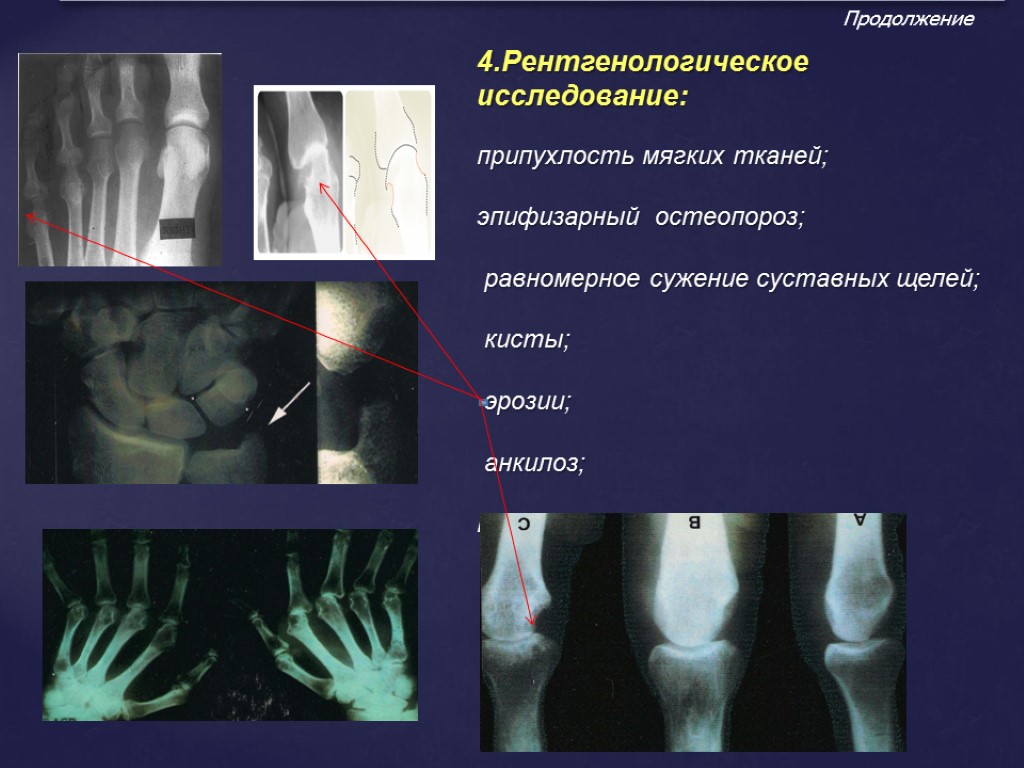 >4.Рентгенологическое исследование: припухлость мягких тканей; эпифизарный остеопороз; равномерное сужение суставных щелей; кисты; эрозии; анкилоз;